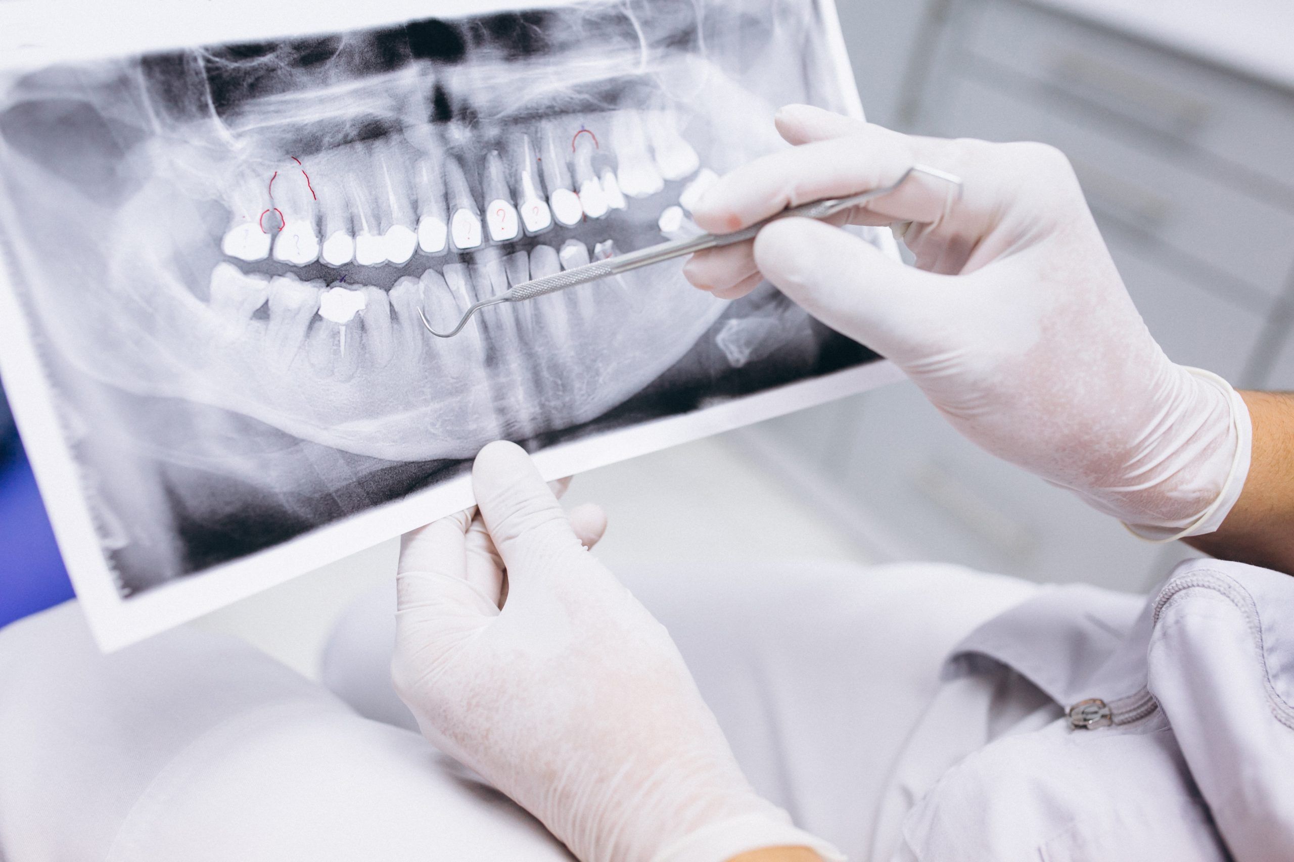 clinica-dental-sabadell-rayos-x-de-dientes