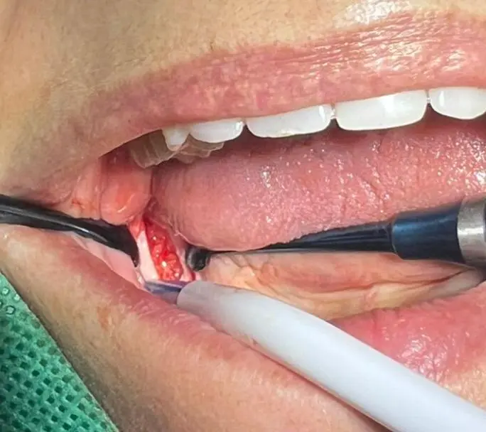 Cirugía de cavitación dental en zona mandibular con aspiración y curetaje